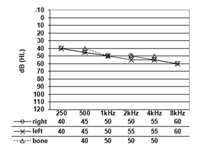 new_audiogram_1.png
